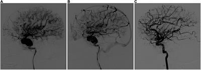 Multiple Pipeline Embolization Devices for the Treatment of Complex Intracranial Aneurysm: A Multi-Center Study